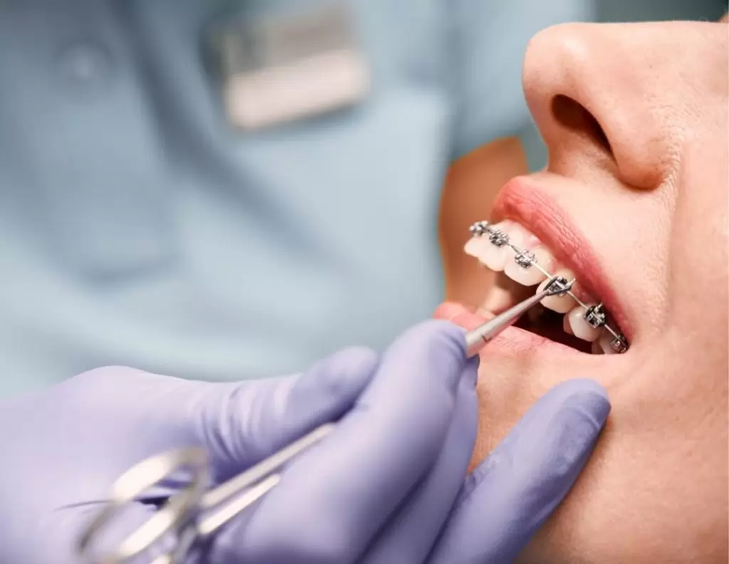 Виды брекетов и их различия