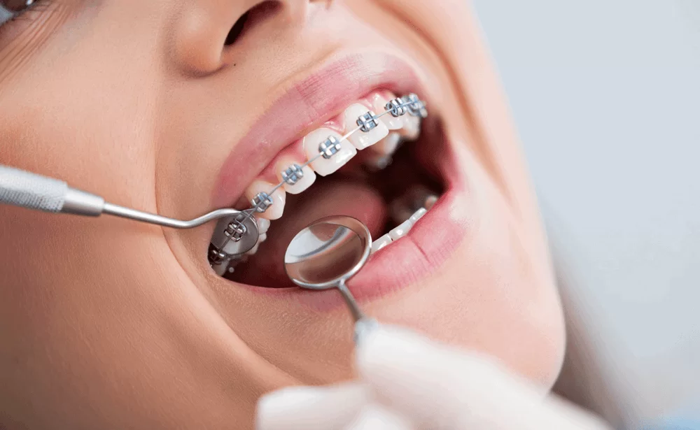 Брекеты для взрослых: когда и зачем они нужны