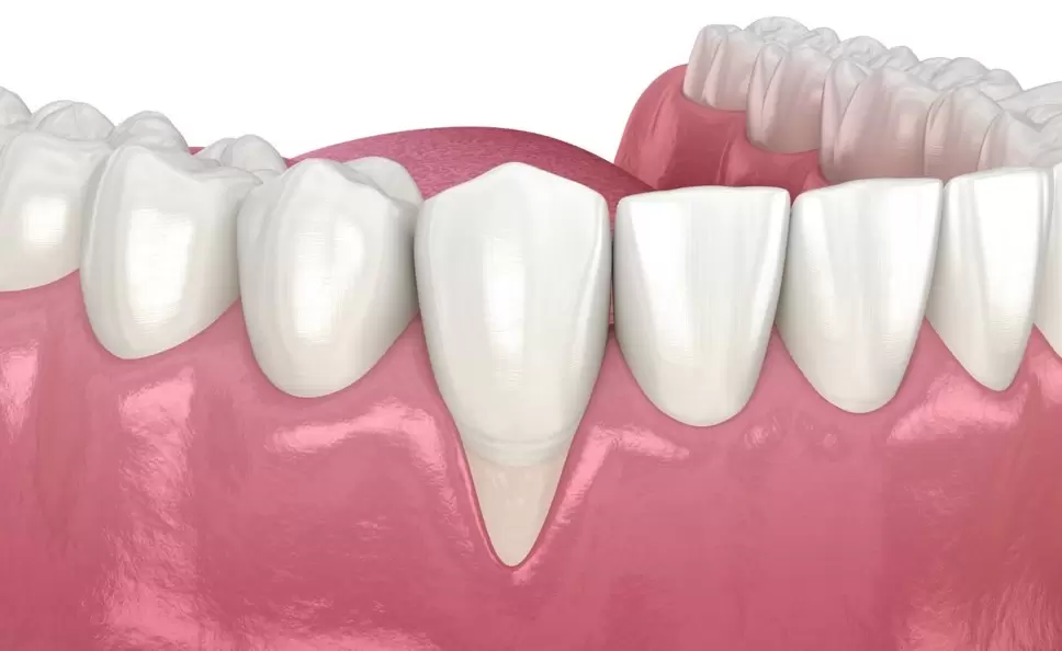 Почему оголяются шейки зубов?