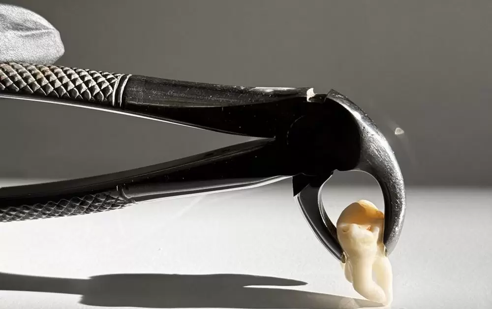 Удаление зубов мудрости: особенности и показания